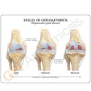 Switch Models show degeneration of the joint, erosion of the cartilage and osteophytes (bone spur) formation 3 image