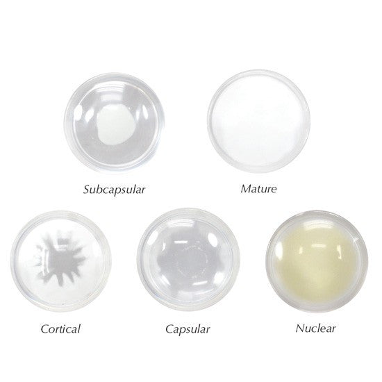 Cataract Eye Model