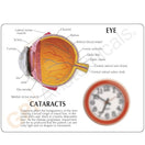 Switch Cutaway model of the eye with 5 interchangeable lenses to demonstrate types of cataracts 2 image