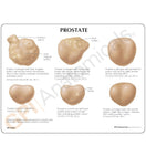 Switch Six life size models of prostate glands demonstrating many conditions 2 image
