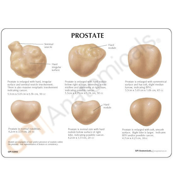 Prostate Conditions Model (6 part) - Part of Collection