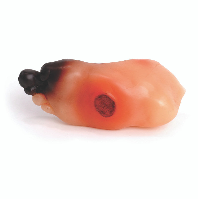 Severe Diabetic Foot Model