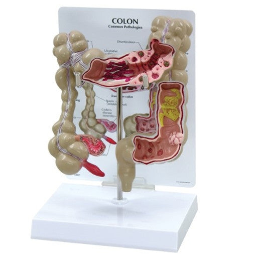 Colon Model with Common Pathologies 3340 | Colon Anatomy Model | GPI ...