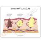 Switch Accurate skin model illustrates comedones and pustules 3 image