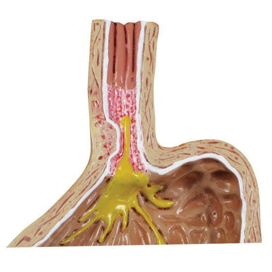 Gastro-oesophageal Reflux Disease (GERD) Model