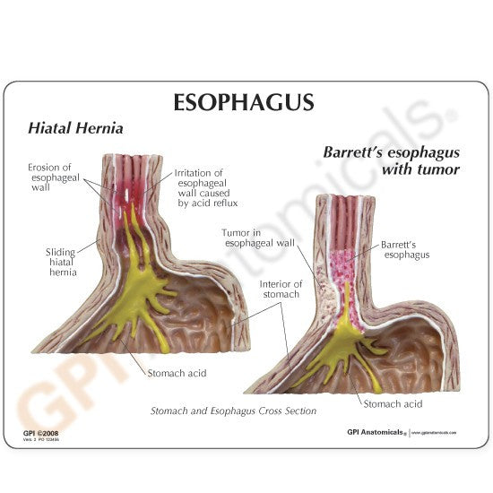 Gastro-oesophageal Reflux Disease (GERD) Model