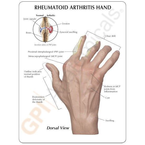 Information card shows labelled anatomy comparing normal and diseased joints