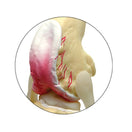 Switch 4-Stage Knee Model Set demonstrates degenerative joint disease 3 image