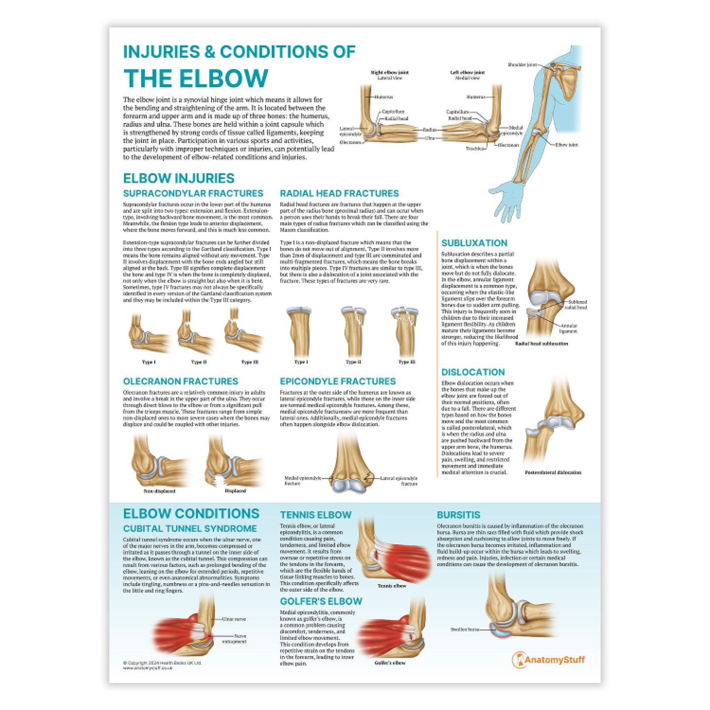 The Anatomy of The Elbow Chart / Poster - Pathology and Injury ...