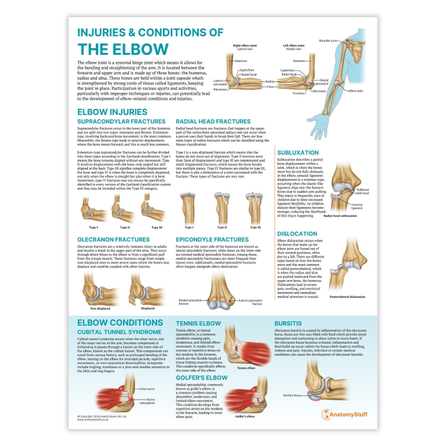 Injuries & Conditions of the Elbow Chart / Poster - Part of Collection