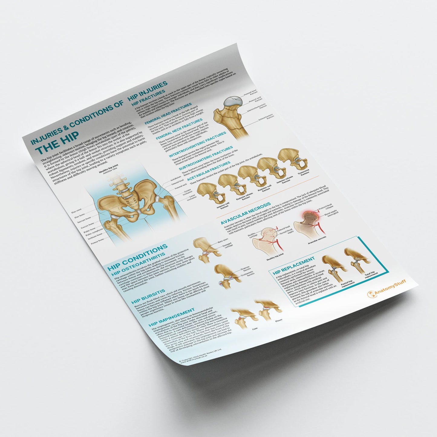 Injuries & Conditions of the Hip Chart / Poster - Part of Collection