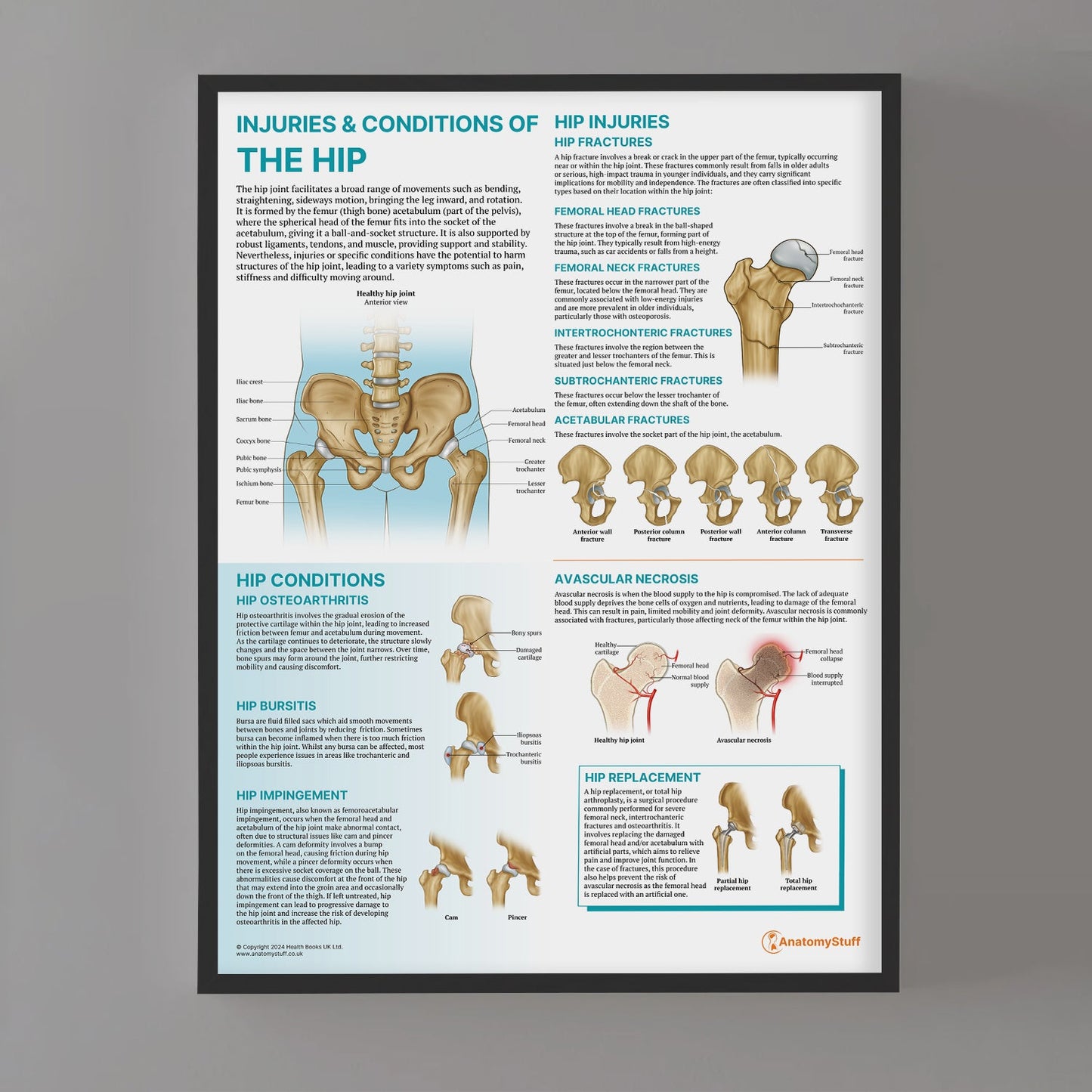 Injuries & Conditions of the Hip Chart / Poster - Part of Collection
