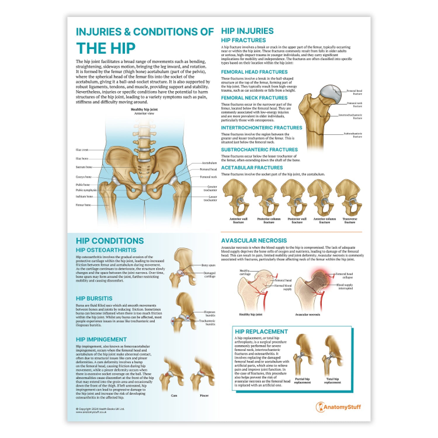 Injuries & Conditions of the Hip Chart / Poster - Part of Collection