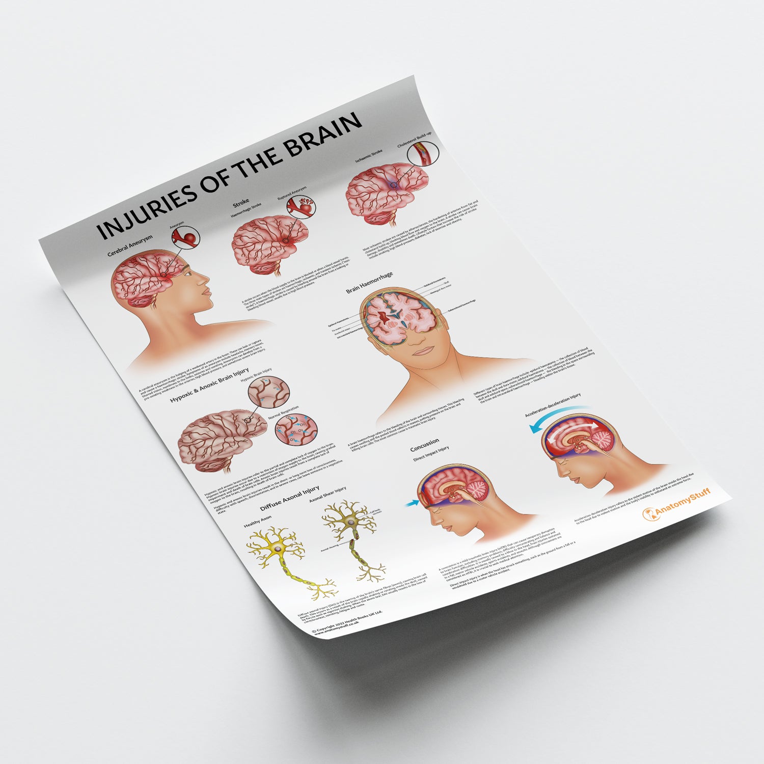 Injuries Of The Brain Chart / Poster