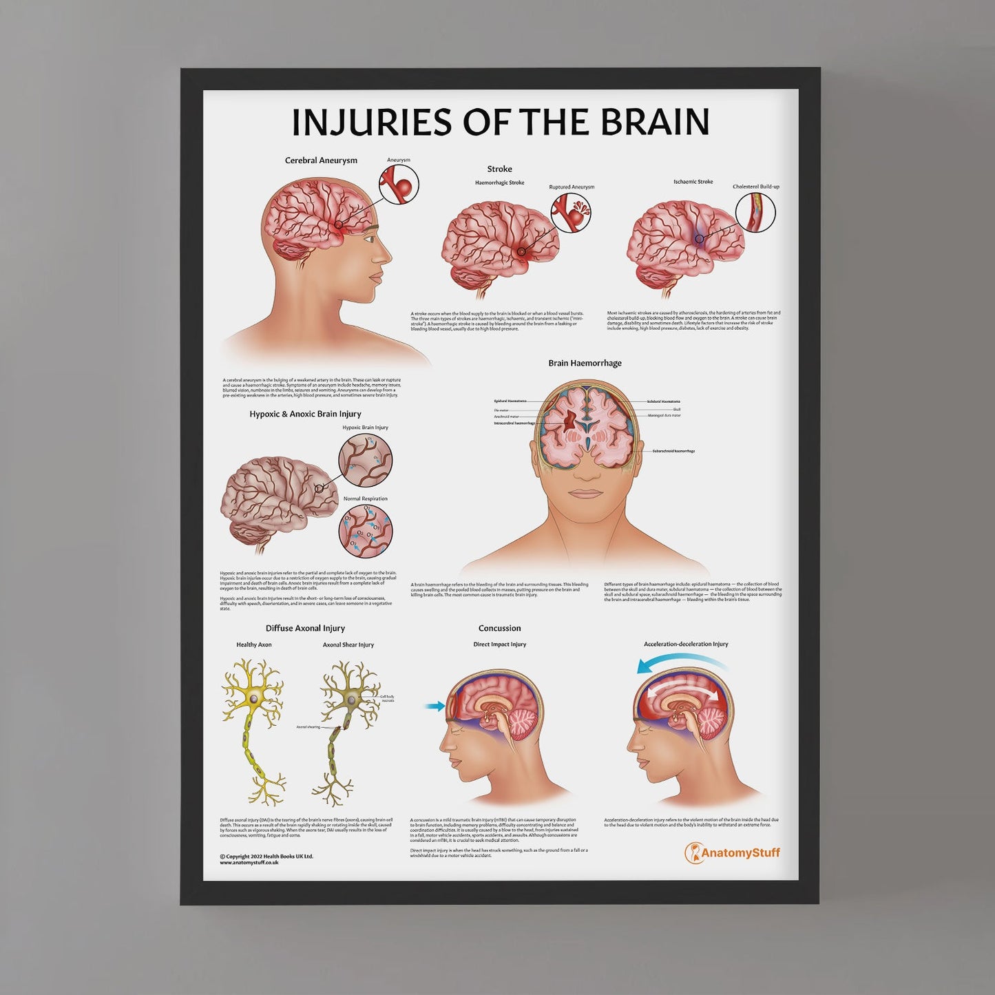 Injuries Of The Brain Chart / Poster - Part of Collection