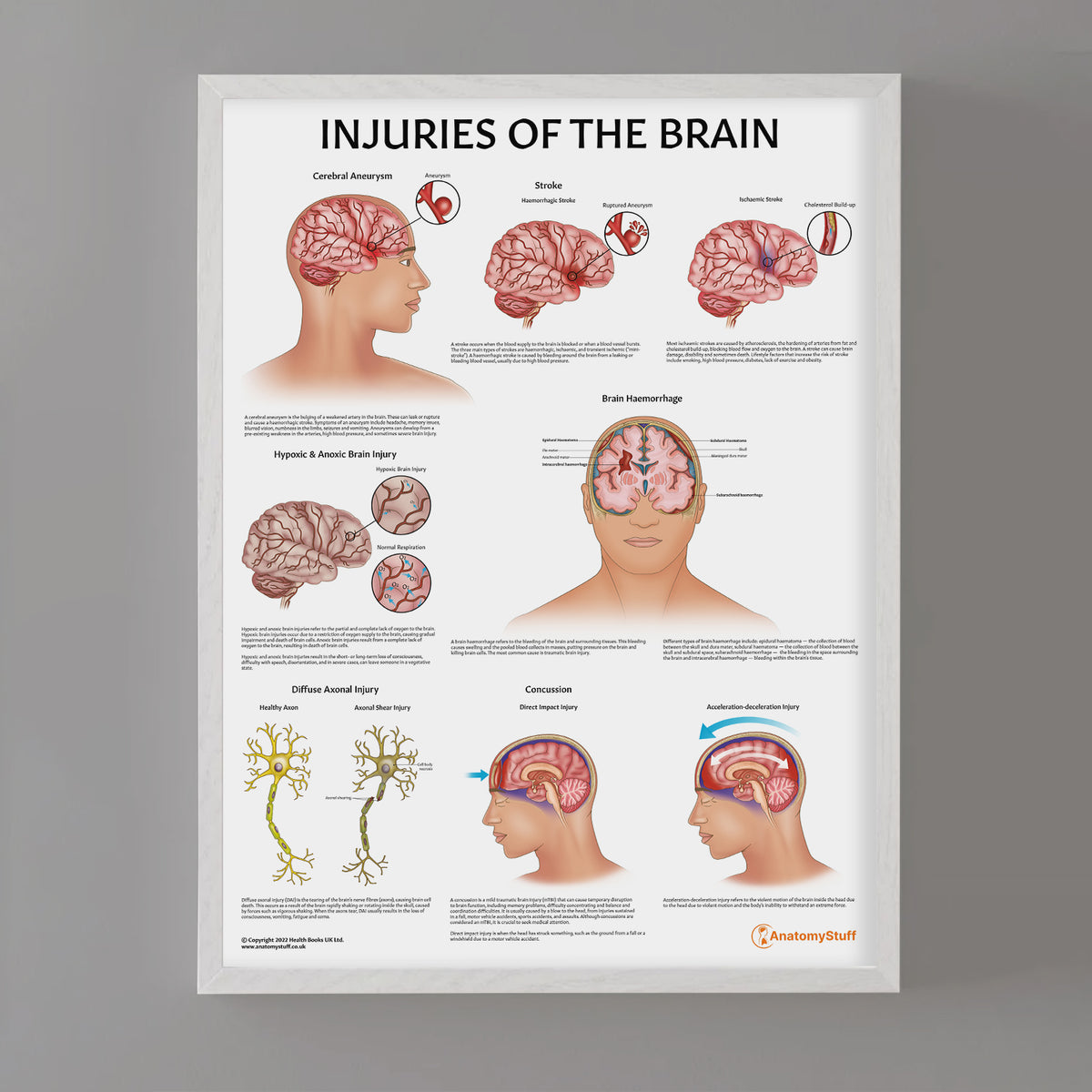 Injuries Of The Brain Chart | Brain Trauma Poster – AnatomyStuff