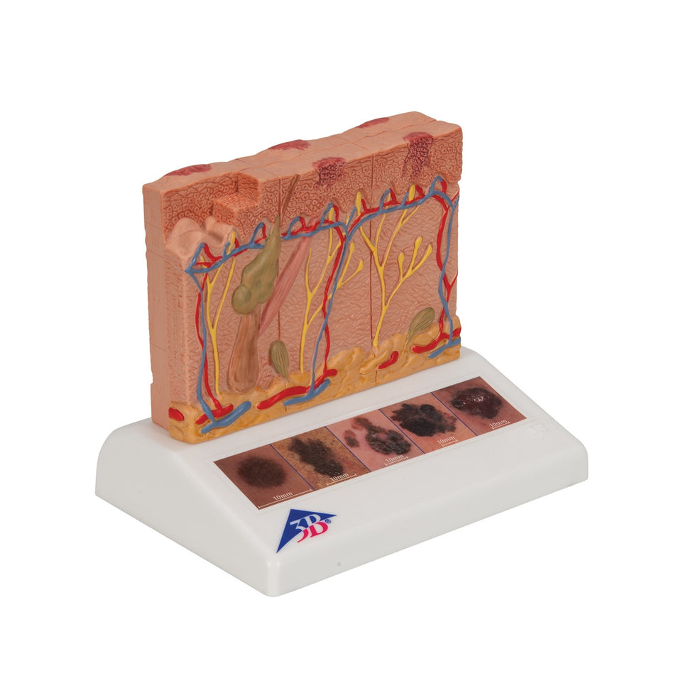 Skin Cancer Model (8 times life size)