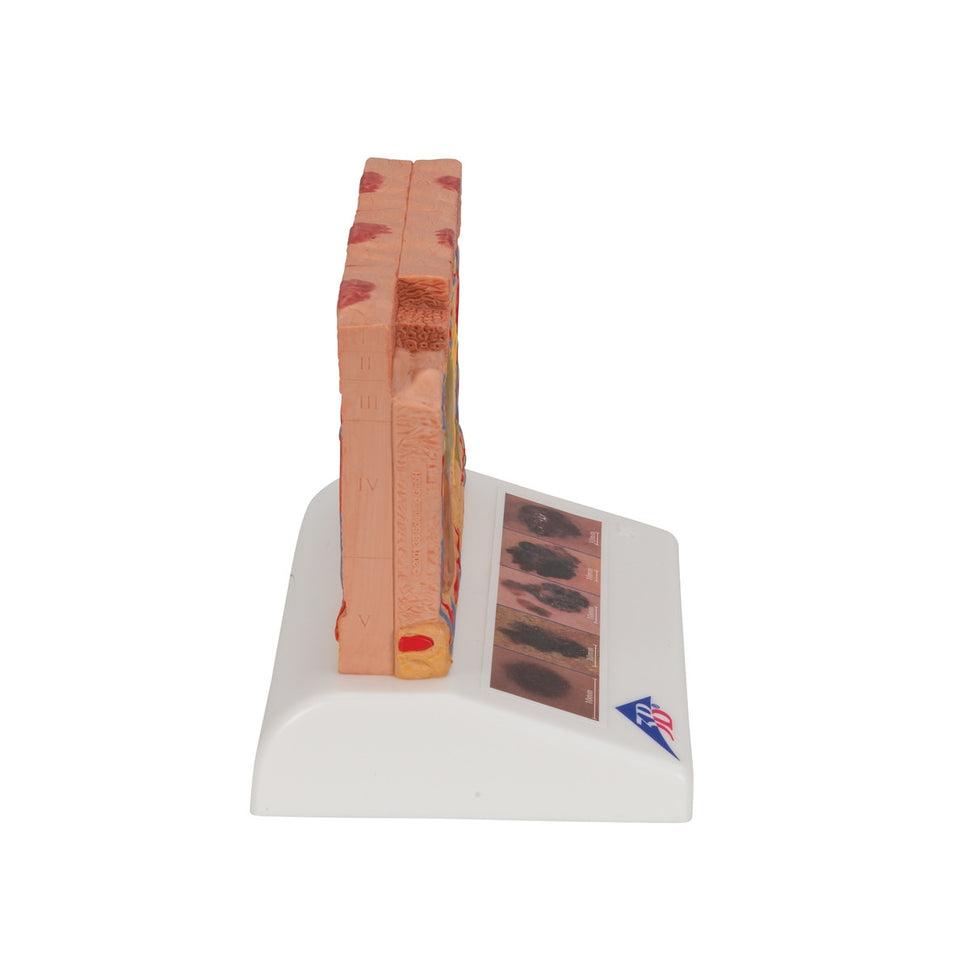 Skin Cancer Model (8 times life size)