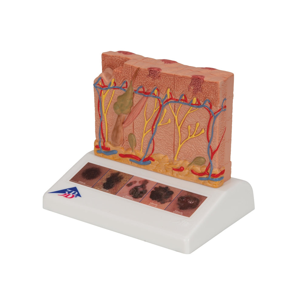 Skin Cancer Model (8 times life size)