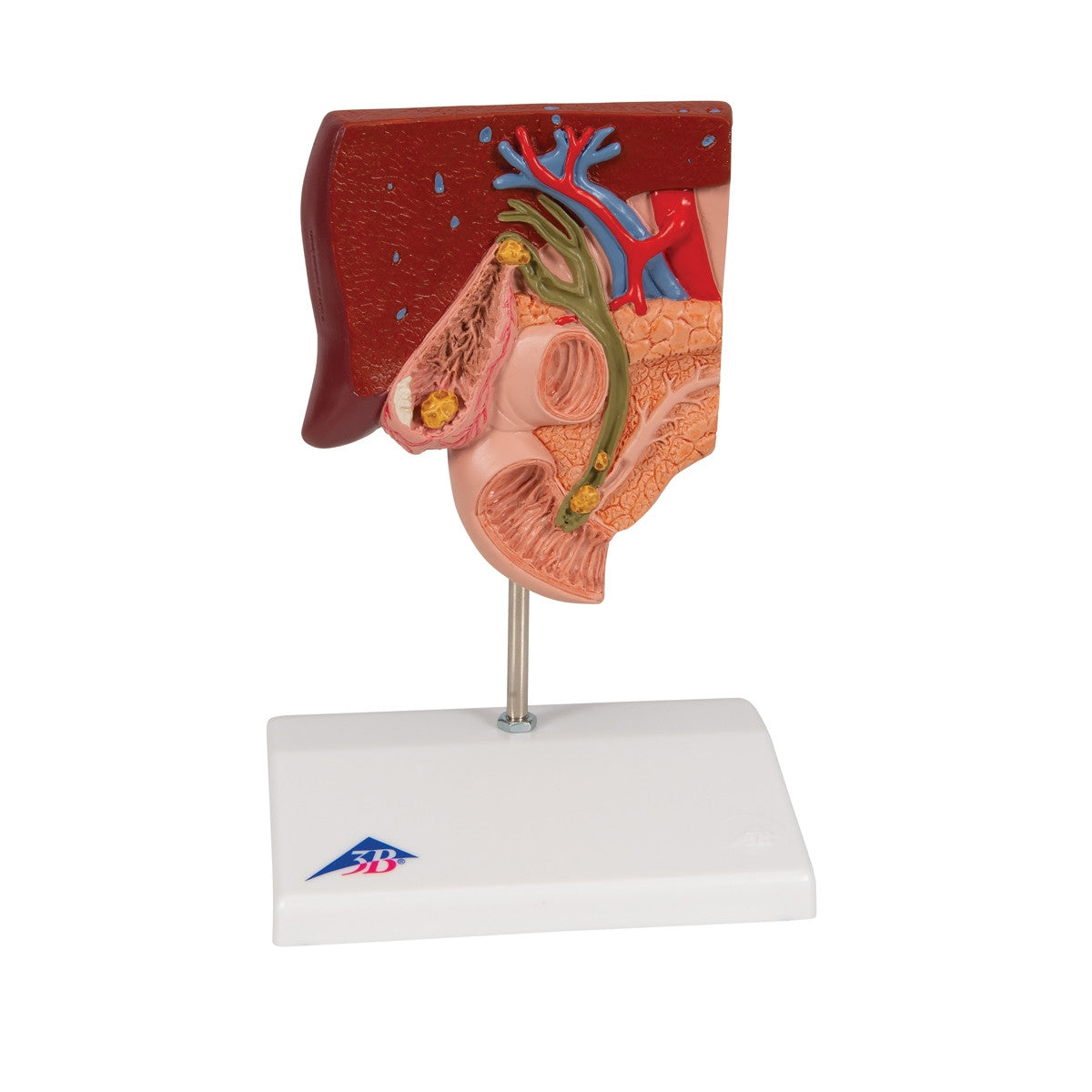 Gallstone Anatomical Model