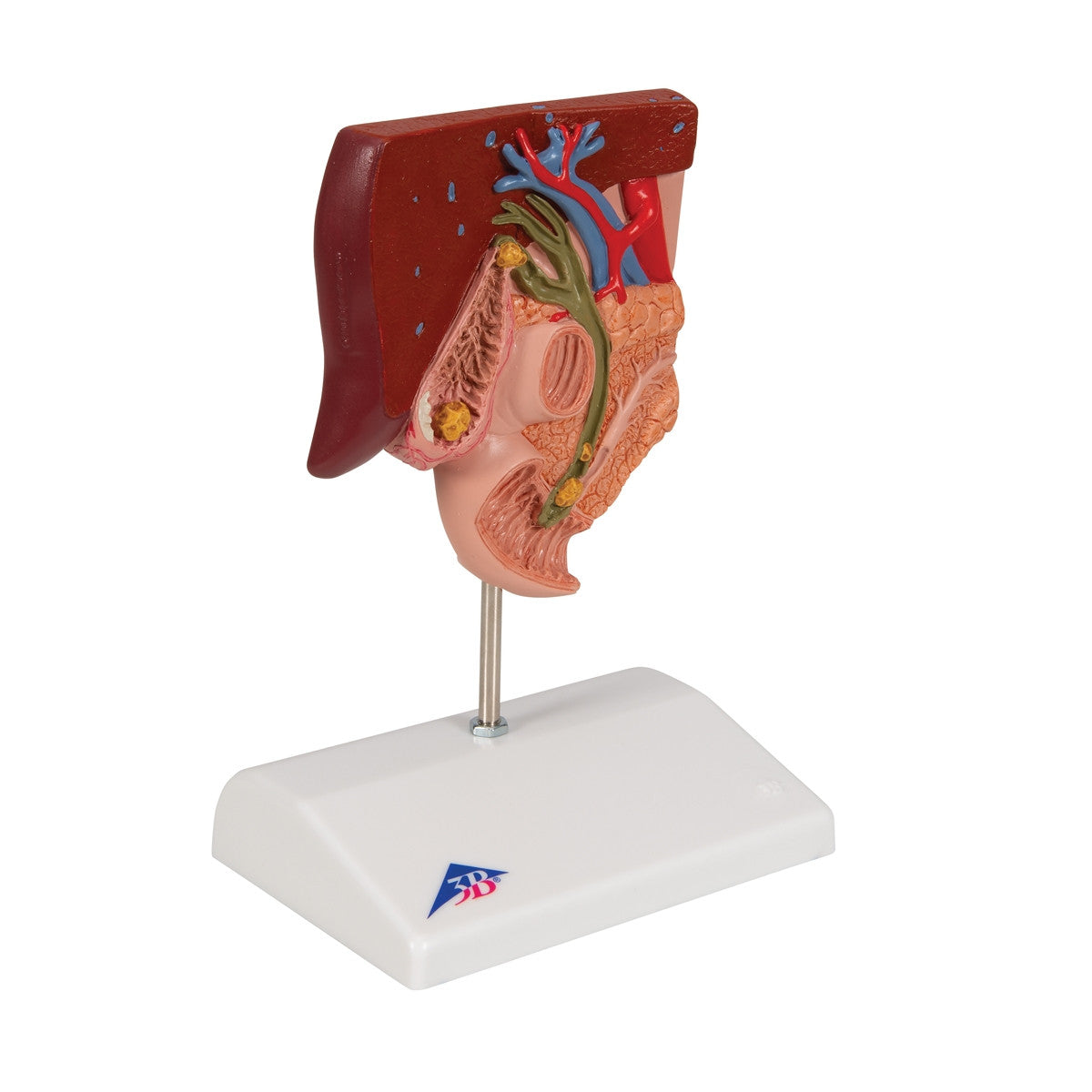 Gallstone Anatomical Model