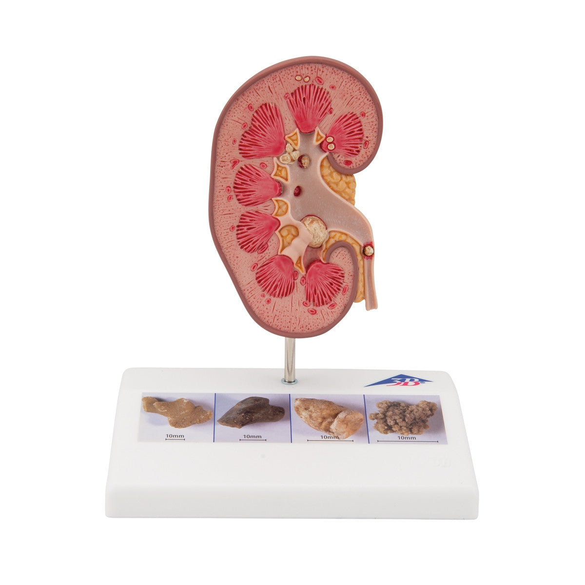 Kidney Stone Anatomical Model