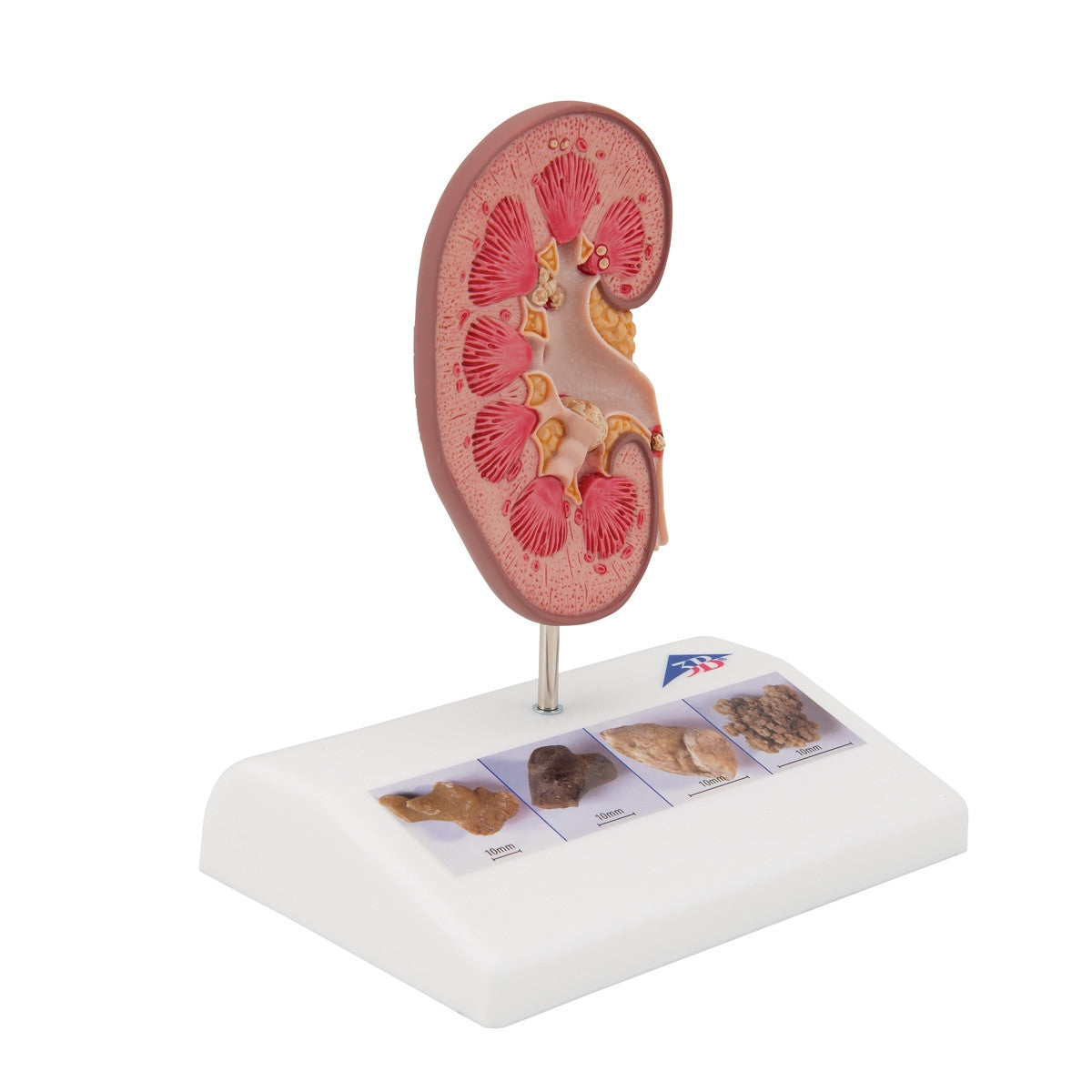 Kidney Stone Anatomical Model