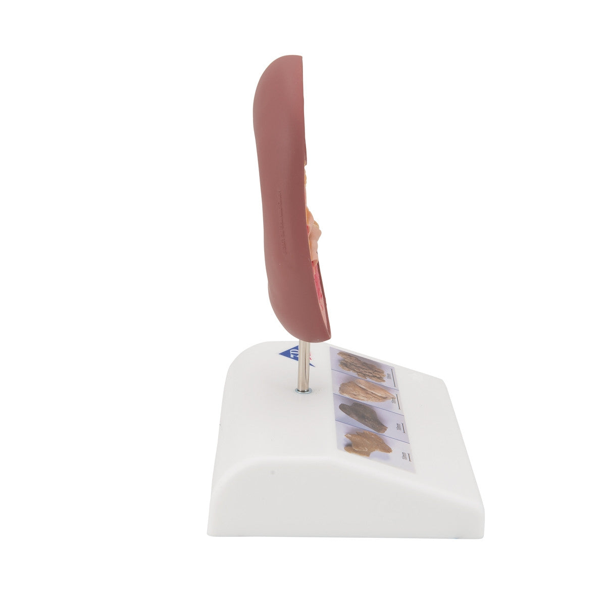 Kidney Stone Anatomical Model