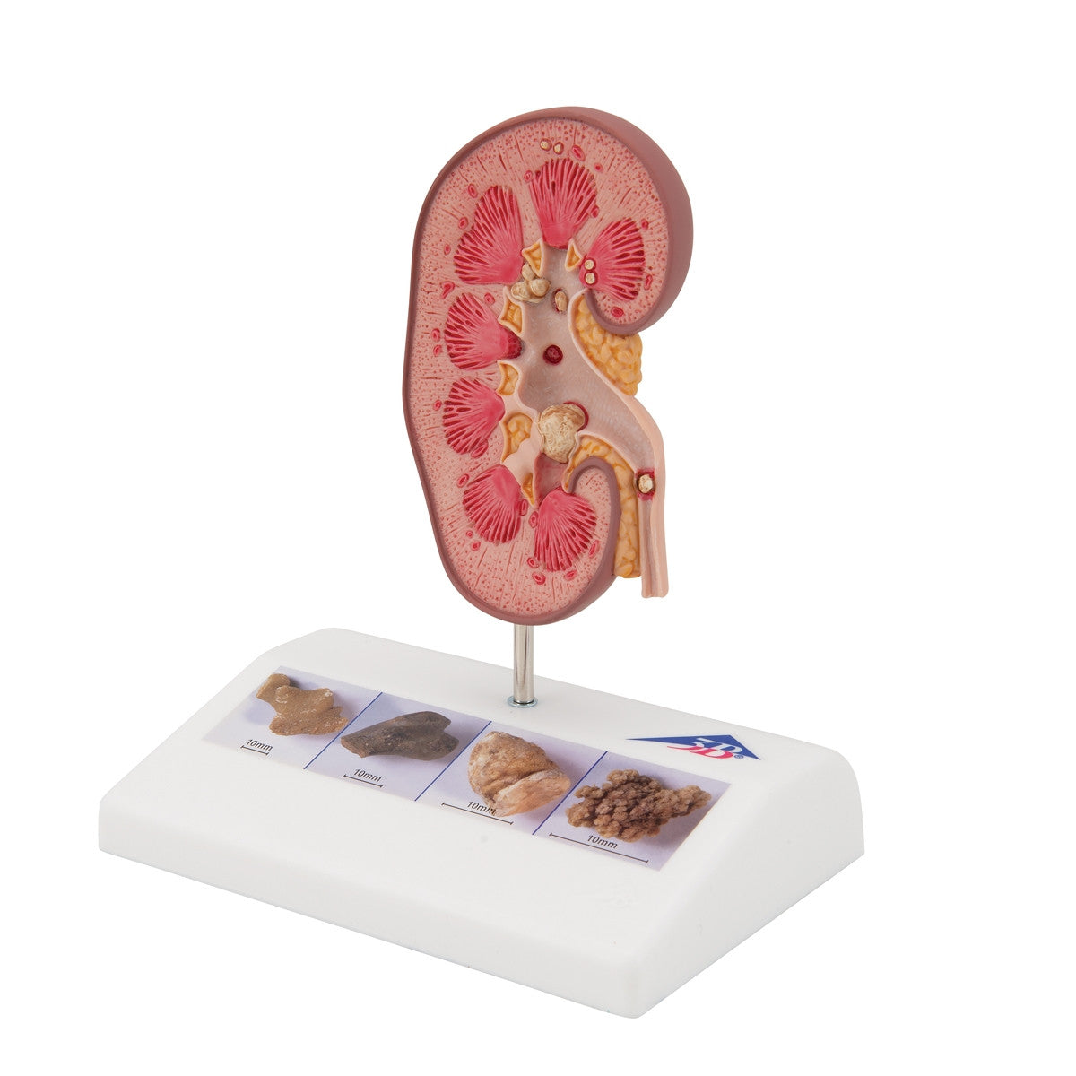 Kidney Stone Anatomical Model