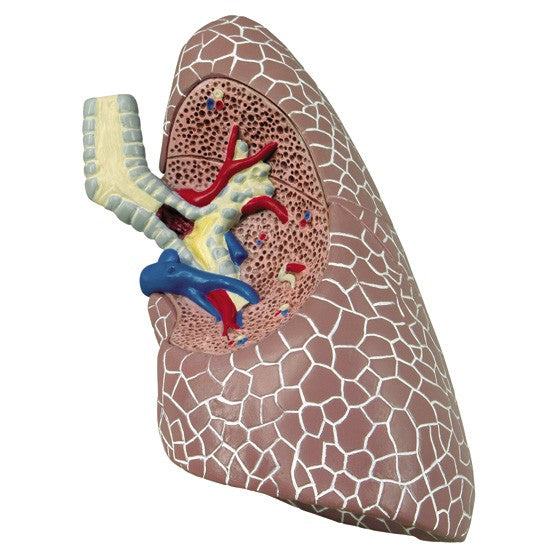 Diseased Lungs Model 3110 single lung