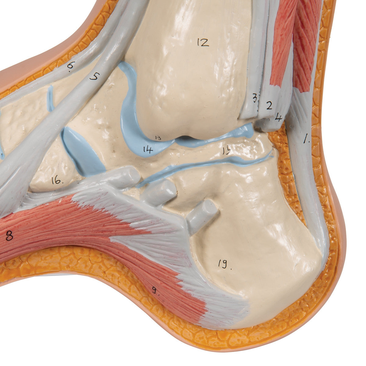 Hollow Foot Model (Pes Cavus)