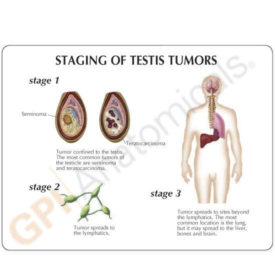 Male Pelvis Section Model with Testicular Cancer 3570  card back