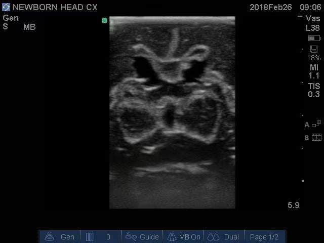 Newborn Head (Complex) for X-Ray CT, US, MRI HD-N01 image 3