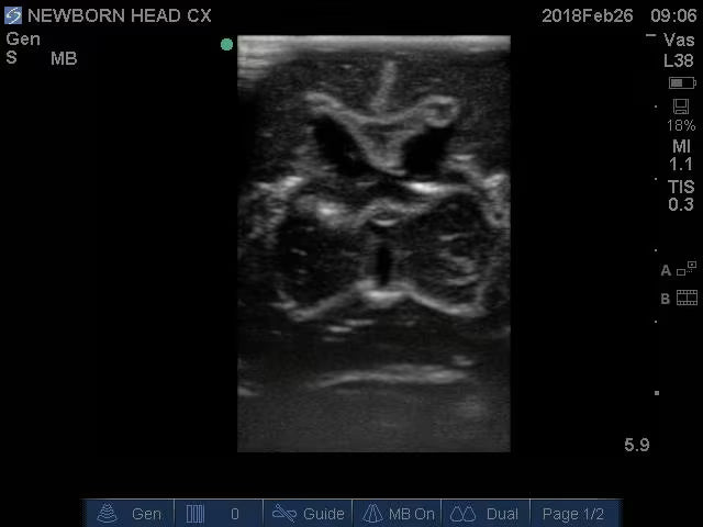 Newborn Head Phantom (Complex) for X-Ray CT, US, MRI