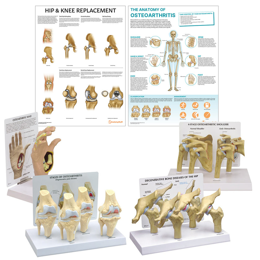 Osteoarthritis (OA) Education Collection