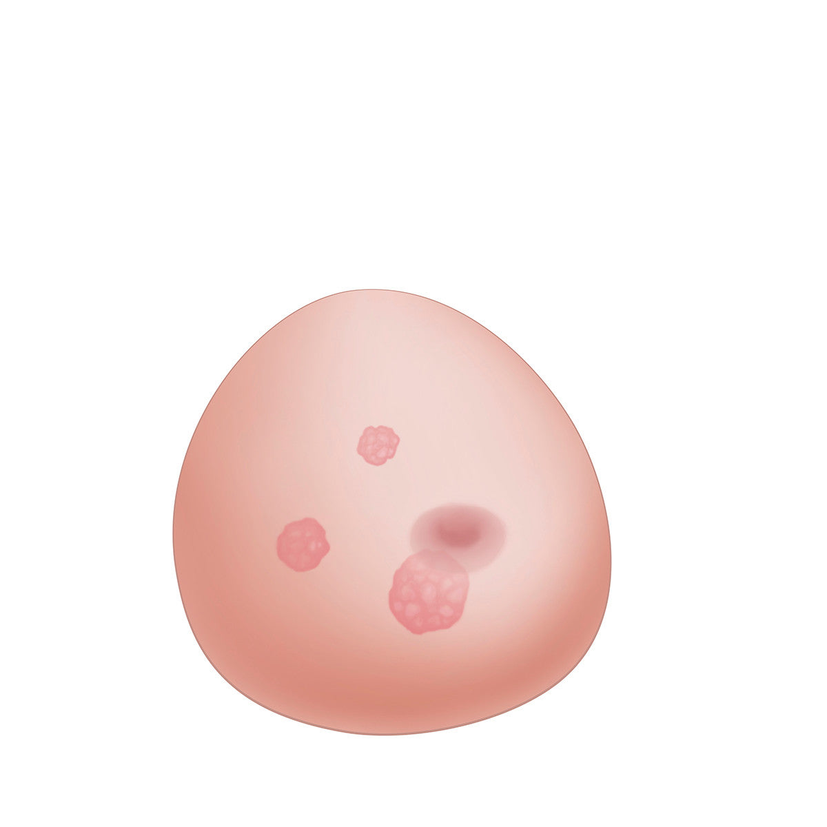 Replacement Block for SONOtrain Breast Model with Tumours