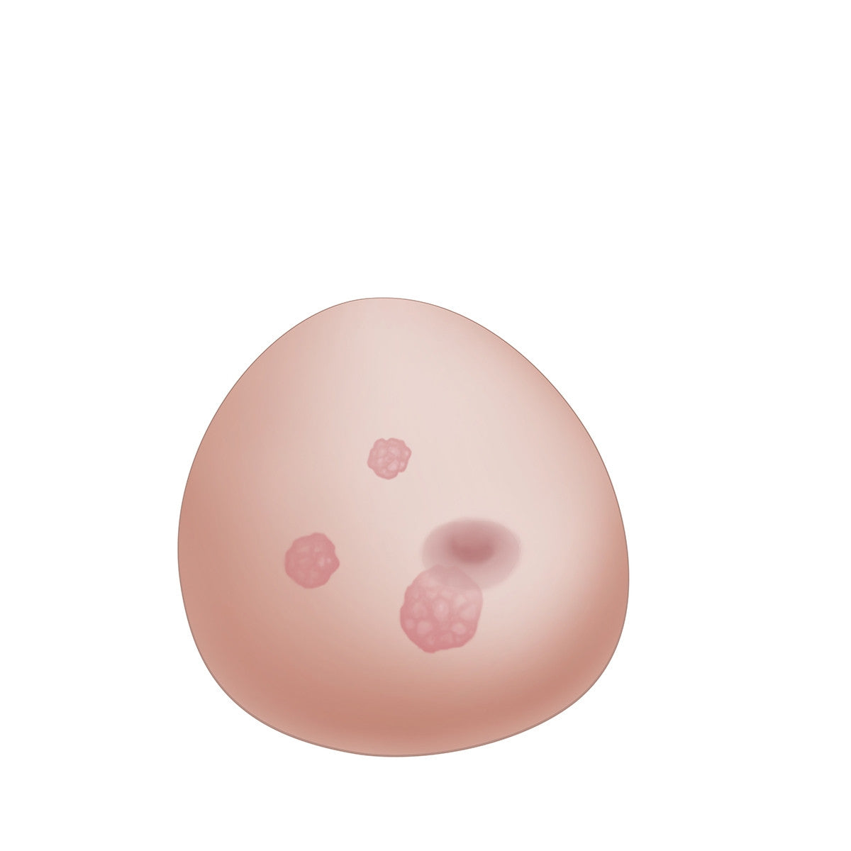 SONOtrain Ultrasound Breast Model with Tumours
