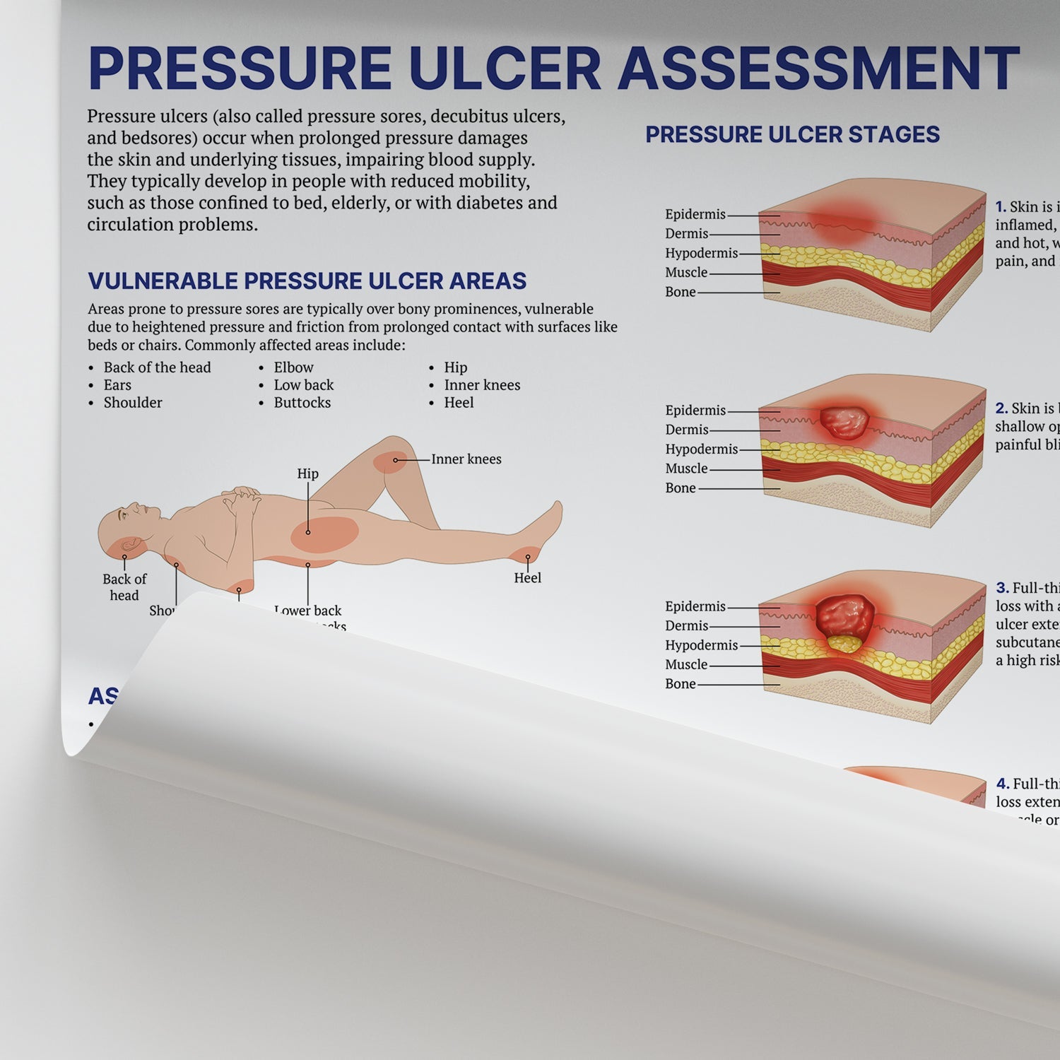 Pressure Ulcer Assessment and Care Chart / Poster - Part of Collection