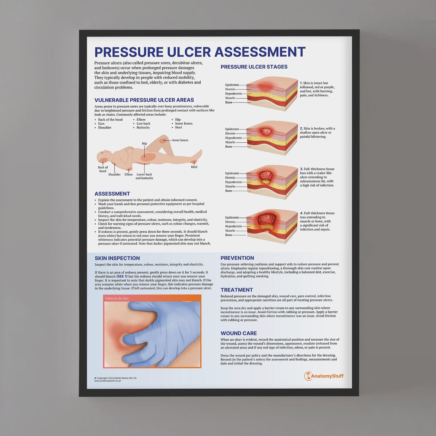Pressure Ulcer Assessment and Care Chart / Poster - Part of Collection