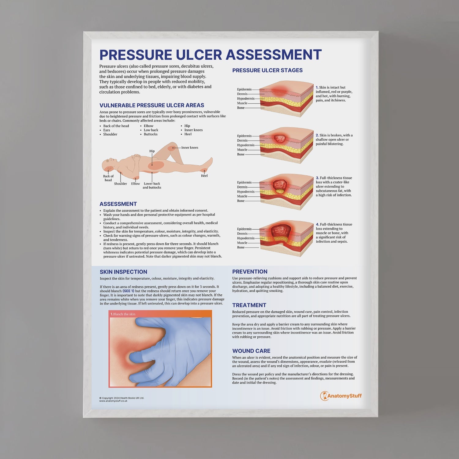 Pressure Ulcer Assessment and Care Chart / Poster - Part of Collection