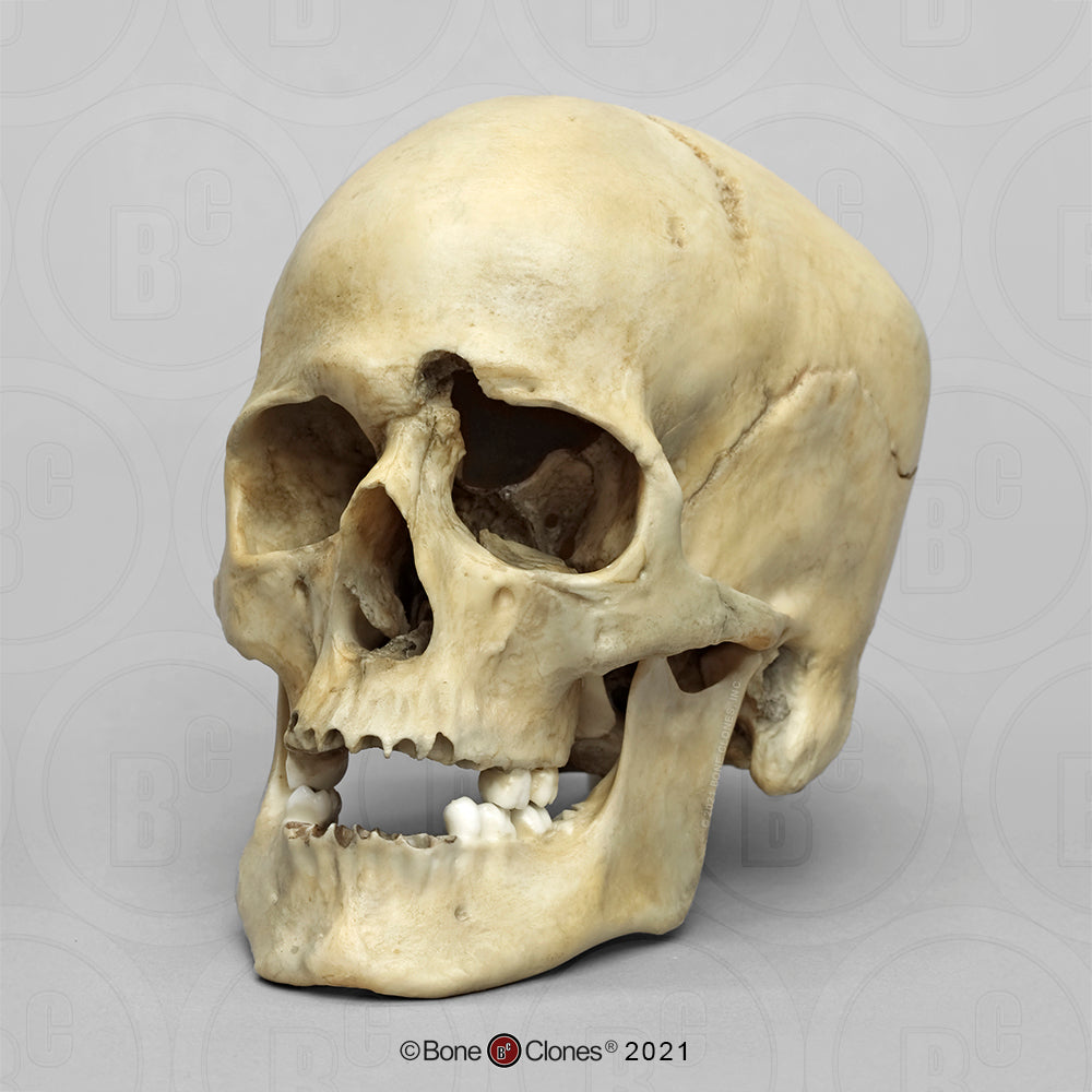 Bone Clones Forensic Trauma Skulls