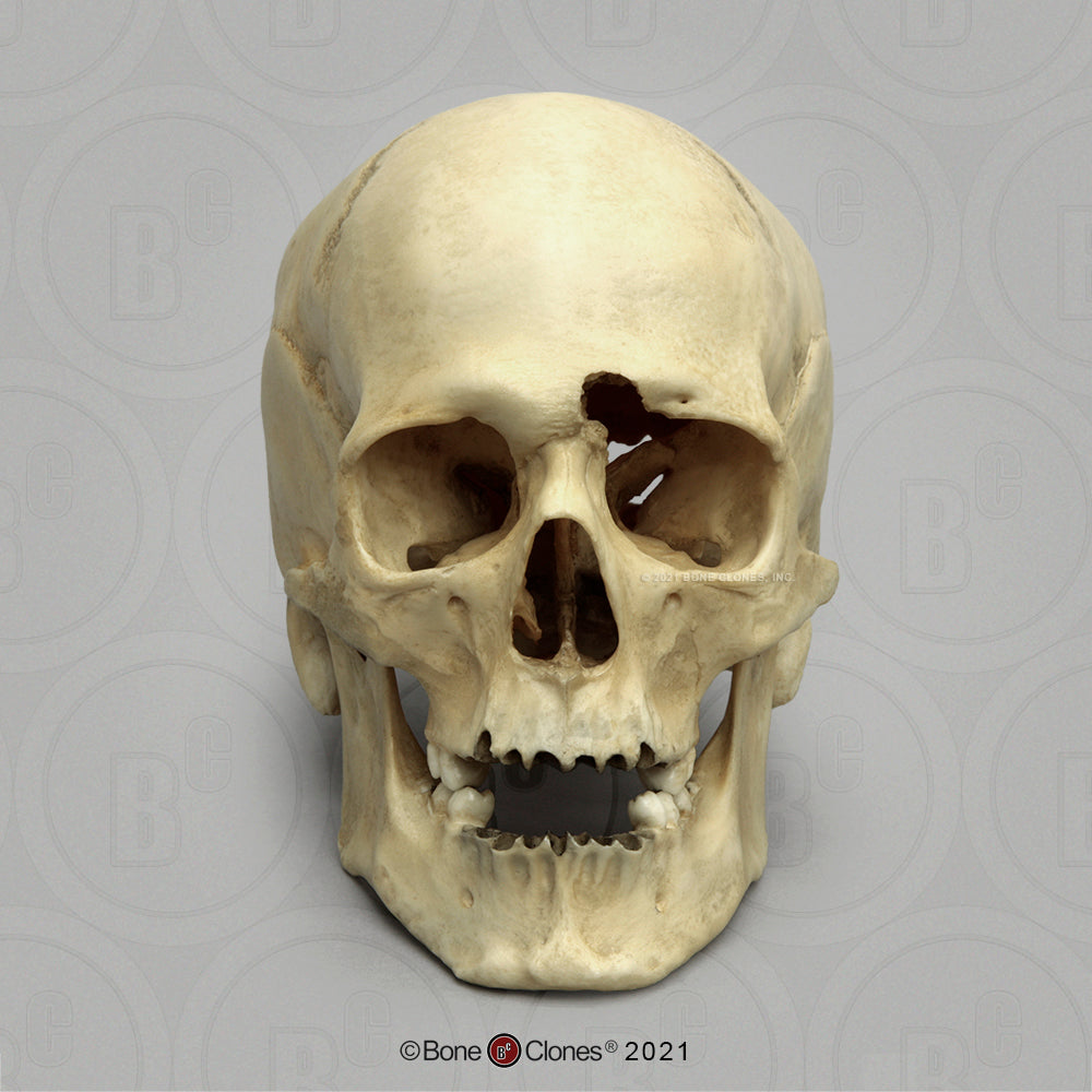 Bone Clones Forensic Trauma Skulls