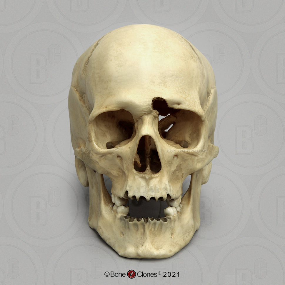 Bone Clones Forensic Trauma Skulls
