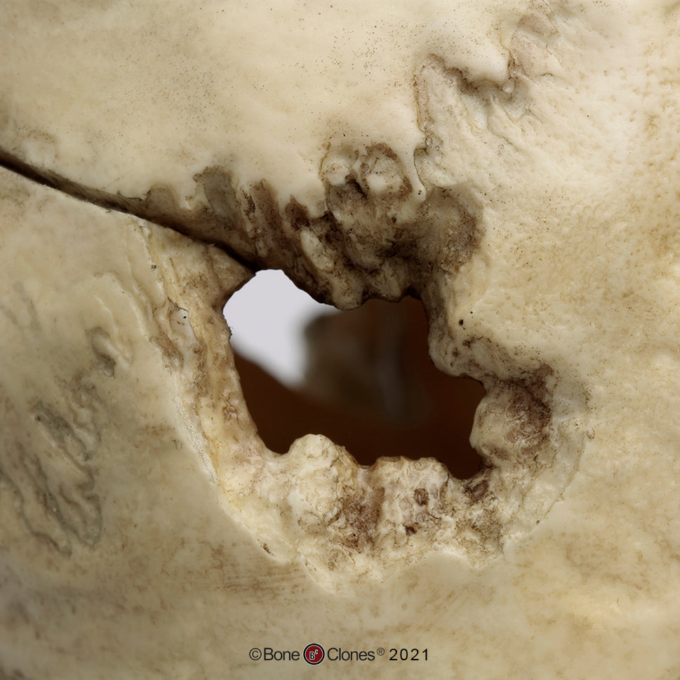 Bone Clones Forensic Trauma Skulls