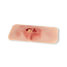 Wound Moulage