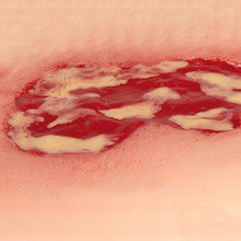Small Wound Moulage Venous Leg Ulcer in Exudation Phase - PW002A