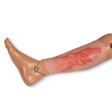 Wound Moulage