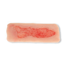 Large Wound Moulage Venous Leg Ulcer in Epithelisation Phase PW003C