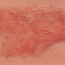 Wound Moulage