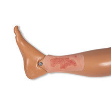 Wound Moulage
